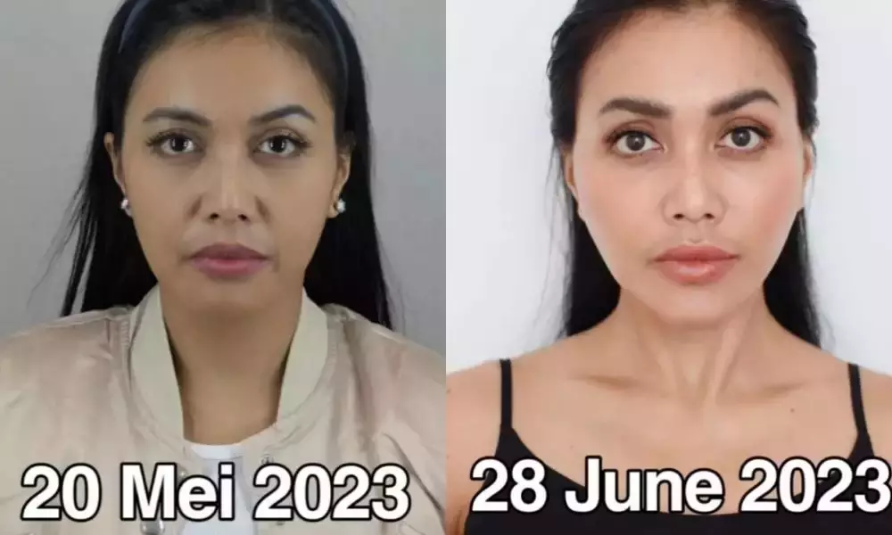 Seleb sebelum dan sesudah face lifting Berbagai sumber