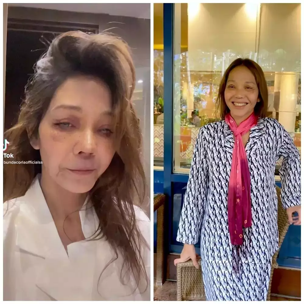 Seleb sebelum dan sesudah face lifting Berbagai sumber