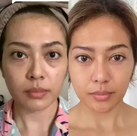 Seleb sebelum dan sesudah face lifting Berbagai sumber