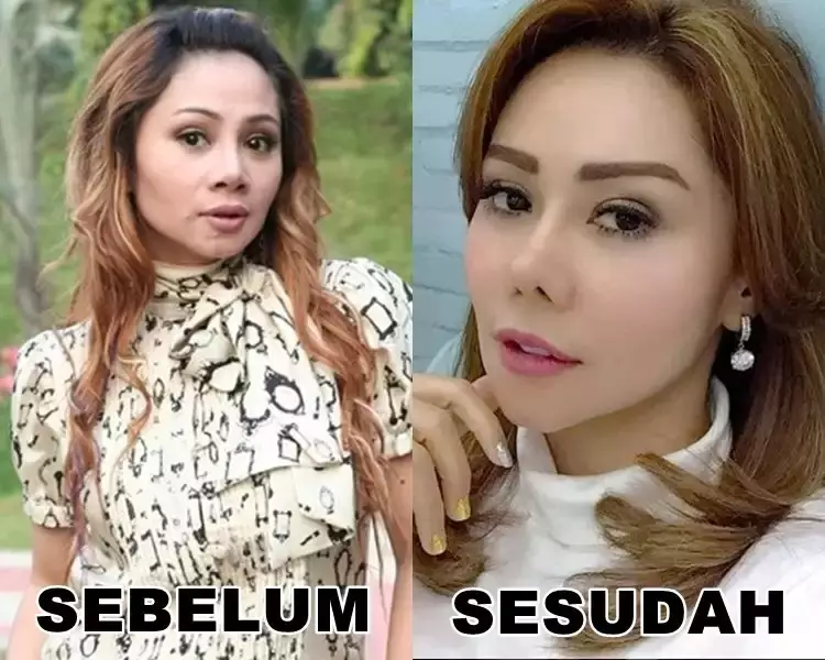 seleb usia 45 tahun suntik botoks Berbagai sumber