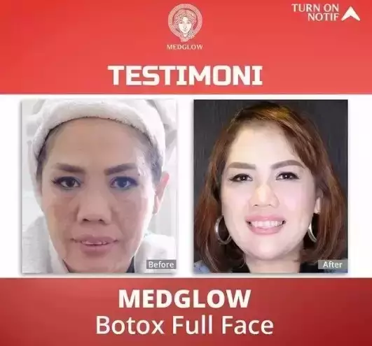 seleb usia 45 tahun suntik botoks Berbagai sumber