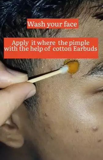 2 bahan dapur mengatasi jerawat matang TikTok 2 bahan dapur mengatasi jerawat matang TikTok