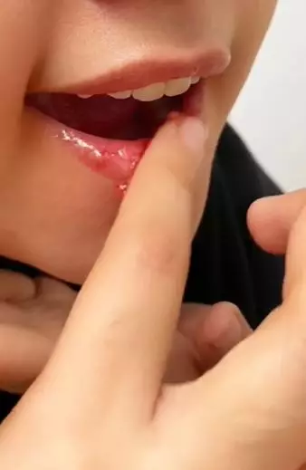 3 Bahan dapur atasi bibir kering pecah-pecah TikTok 3 Bahan dapur atasi bibir kering pecah-pecah TikTok