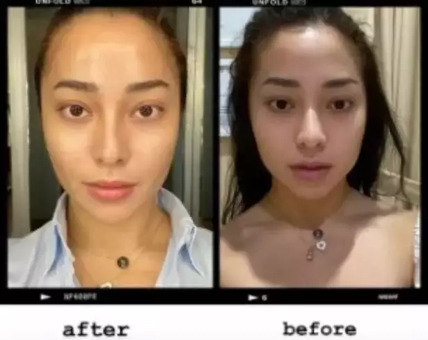 21 Seleb sebelum dan sesudah suntik botoks Berbagai sumber 21 Seleb sebelum dan sesudah suntik botoks Berbagai sumber