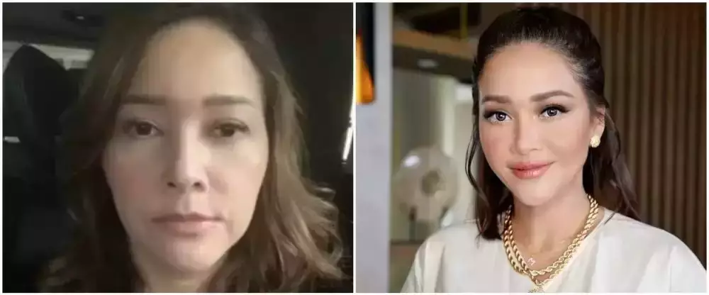 21 Seleb sebelum dan sesudah suntik botoks Berbagai sumber 21 Seleb sebelum dan sesudah suntik botoks Berbagai sumber