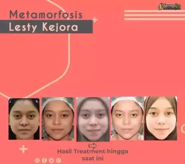 21 Seleb sebelum dan sesudah suntik botoks Berbagai sumber 21 Seleb sebelum dan sesudah suntik botoks Berbagai sumber