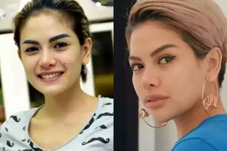 21 Seleb sebelum dan sesudah suntik botoks Berbagai sumber 21 Seleb sebelum dan sesudah suntik botoks Berbagai sumber