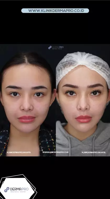 Amanda Manopo jalani tanam benang © Instagram Amanda Manopo jalani tanam benang © Instagram