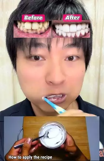 Pria atasi gigi tampak menguning pakai 2 bahan TikTok