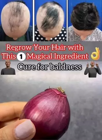 Atasi rambut botak agar tumbuh lebat Berbagai sumber Atasi rambut botak agar tumbuh lebat Berbagai sumber