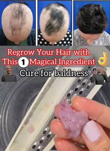 Atasi rambut botak agar tumbuh lebat Berbagai sumber Atasi rambut botak agar tumbuh lebat Berbagai sumber