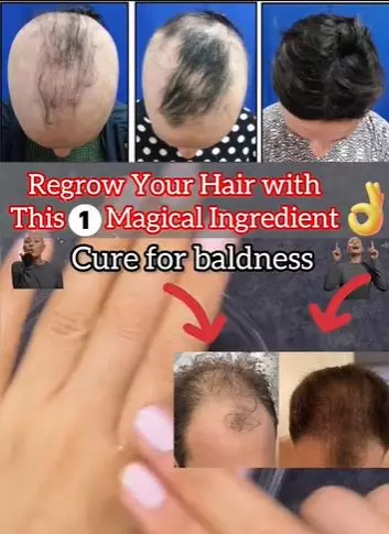 Atasi rambut botak agar tumbuh lebat Berbagai sumber Atasi rambut botak agar tumbuh lebat Berbagai sumber