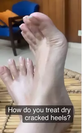 wanita ini bagikan cara atasi telapak kaki kasar berbagai sumber wanita ini bagikan cara atasi telapak kaki kasar berbagai sumber