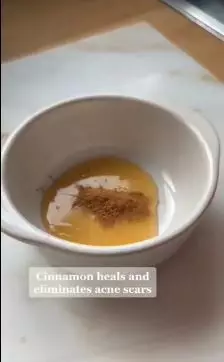 cara atasi kulit wajah berjerawat. berbagai sumber