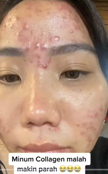 Perubahan kulit cewek usai minum kolagen yang menyebabkan breakout  TikTok