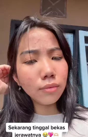 Perubahan kulit cewek usai minum kolagen yang menyebabkan breakout  TikTok