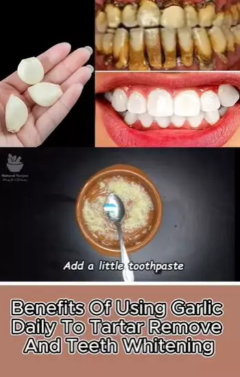 Bawang putih dicampur 1 jenis buah bisa atasi gigi bernoda kuning Berbagai sumber