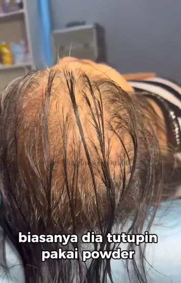 Cewek rambut tipis hampir botak usai treatment hasilnya bak hair extension TikTok