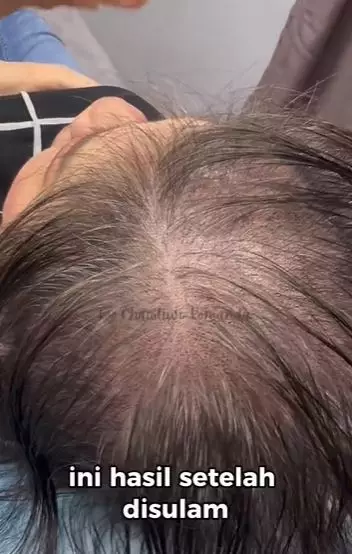 Cewek rambut tipis hampir botak usai treatment hasilnya bak hair extension TikTok