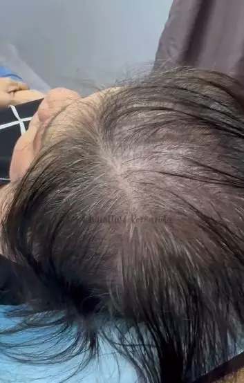 Cewek rambut tipis hampir botak usai treatment hasilnya bak hair extension TikTok