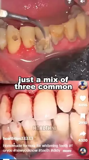 Kulit pisang dicampur 2 bahan dapur bisa atasi gigi bernoda kuning Berbagai sumber