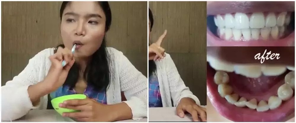 Cara memutihkan dan menghilangkan karang gigi © YouTube