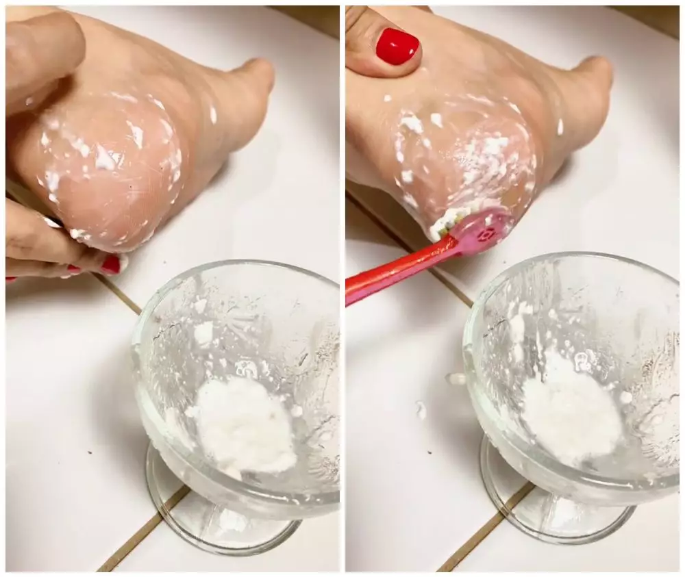 Tumit pecah-pecah © Facebook