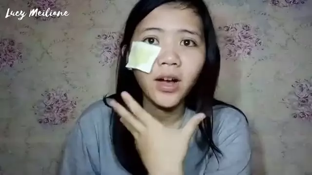 cara hilangkan milia di wajah © YouTube cara hilangkan milia di wajah © YouTube