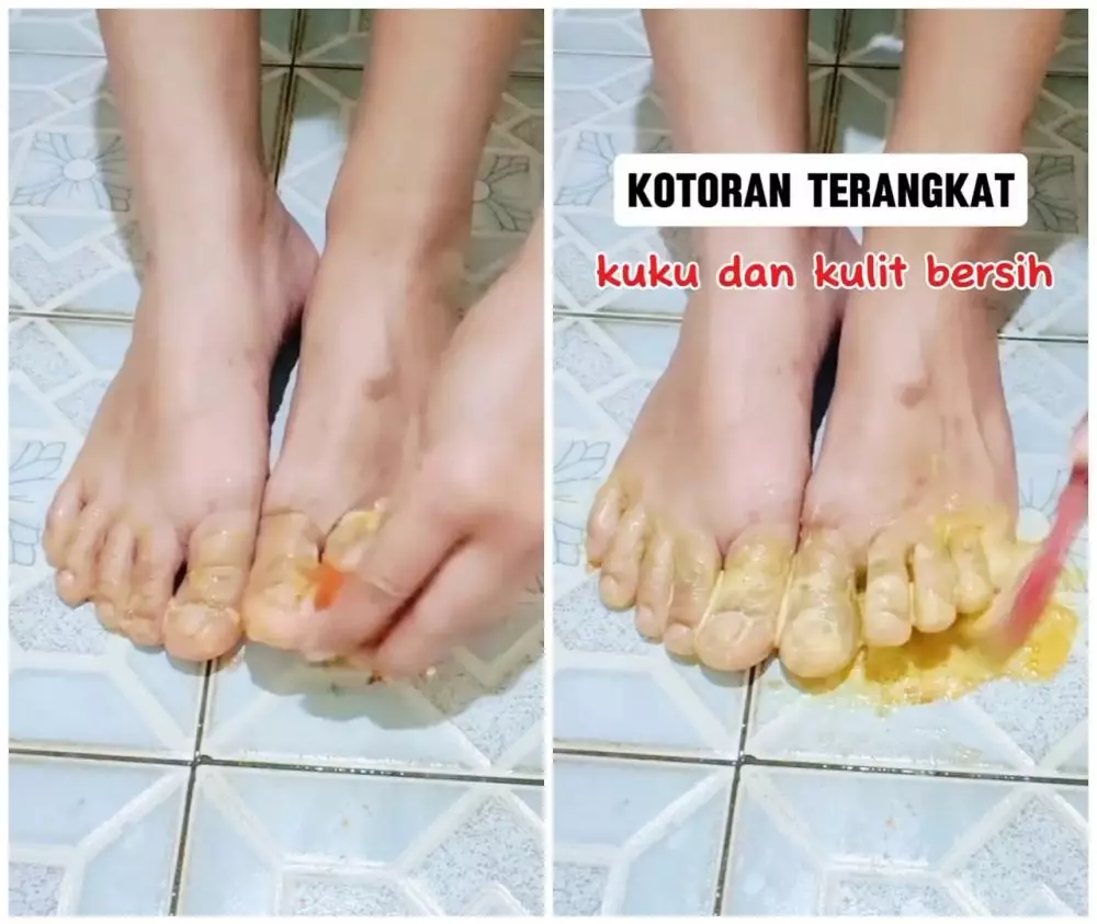 cara bersihkan kotoran kuku kaki © Instagram cara bersihkan kotoran kuku kaki © Instagram