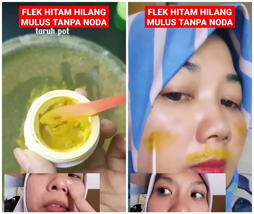 Cara menghilangkan flek hitam © YouTube Cara menghilangkan flek hitam © YouTube