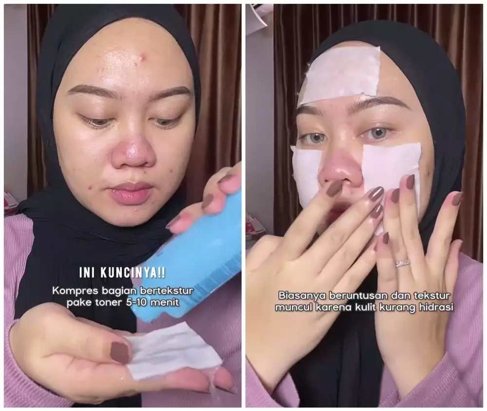 Kulit wajah bertekstur karena bruntusan © Instagram Kulit wajah bertekstur karena bruntusan © Instagram