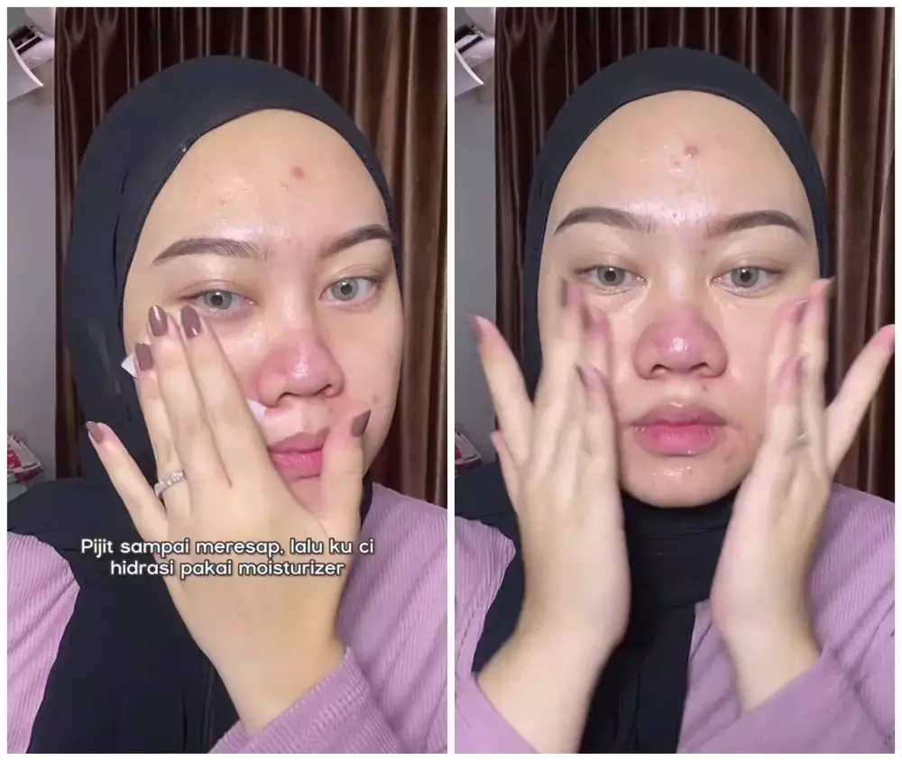 Kulit wajah bertekstur karena bruntusan © Instagram Kulit wajah bertekstur karena bruntusan © Instagram