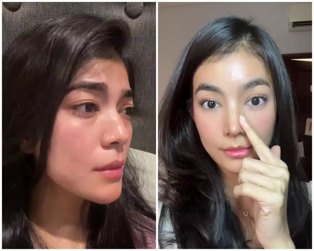 before-after Raya Kohandi usai jalani operasi © Instagram