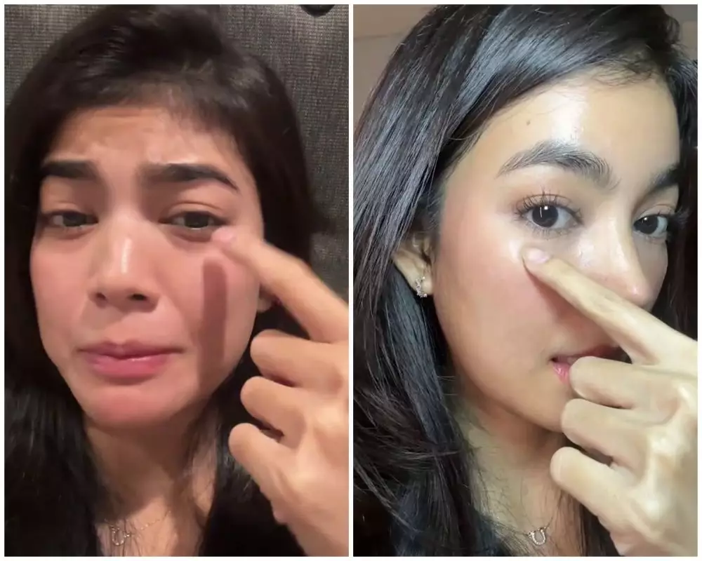 before-after Raya Kohandi usai jalani operasi © Instagram