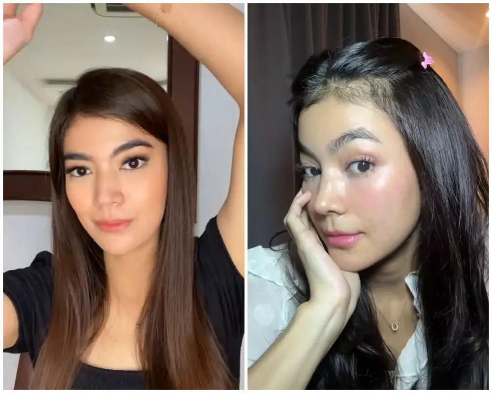 before-after Raya Kohandi usai jalani operasi © Instagram