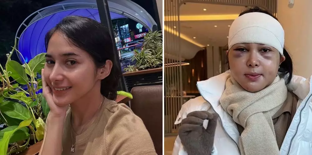 pilih oplas meski sudah cantik alami © 2025 brilio.net pilih oplas meski sudah cantik alami © 2025 brilio.net