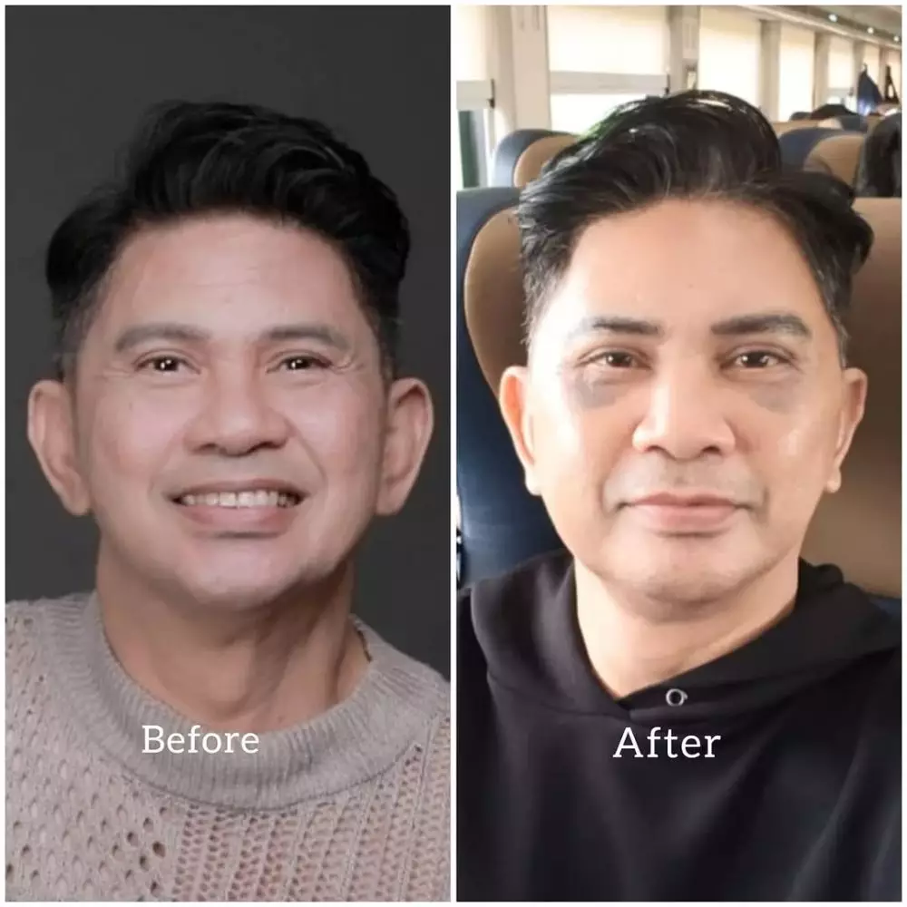 before-after Ronnie Sianturi © Instagram