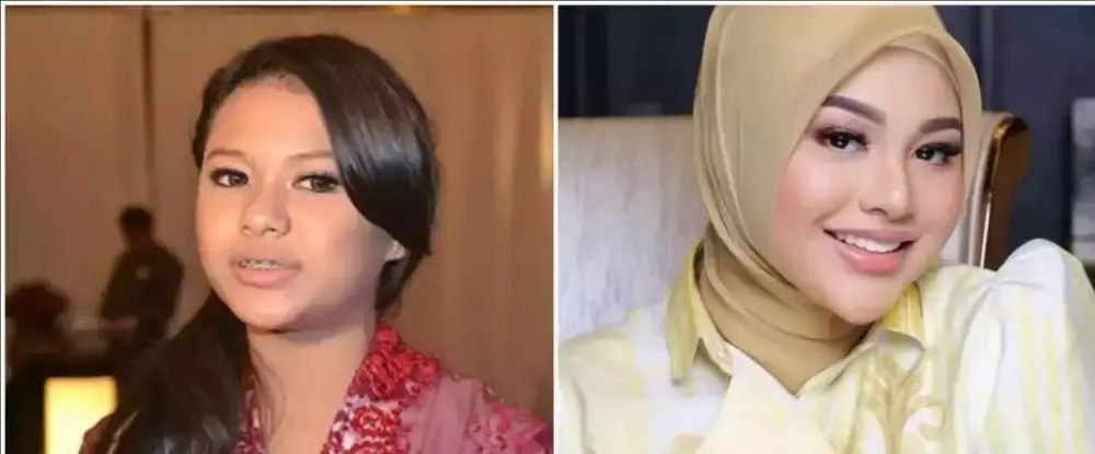 10 potret penyanyi veneer gigi © 2025 brilio.net