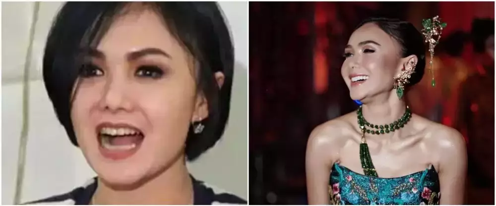 10 potret penyanyi veneer gigi © 2025 brilio.net