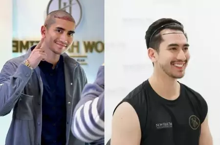 13 seleb transplantasi rambut © 2025 brilio.net 13 seleb transplantasi rambut © 2025 brilio.net