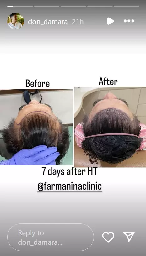 13 seleb transplantasi rambut © 2025 brilio.net 13 seleb transplantasi rambut © 2025 brilio.net