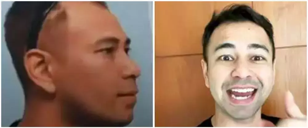 13 seleb transplantasi rambut © 2025 brilio.net 13 seleb transplantasi rambut © 2025 brilio.net