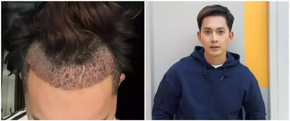 13 seleb transplantasi rambut © 2025 brilio.net 13 seleb transplantasi rambut © 2025 brilio.net