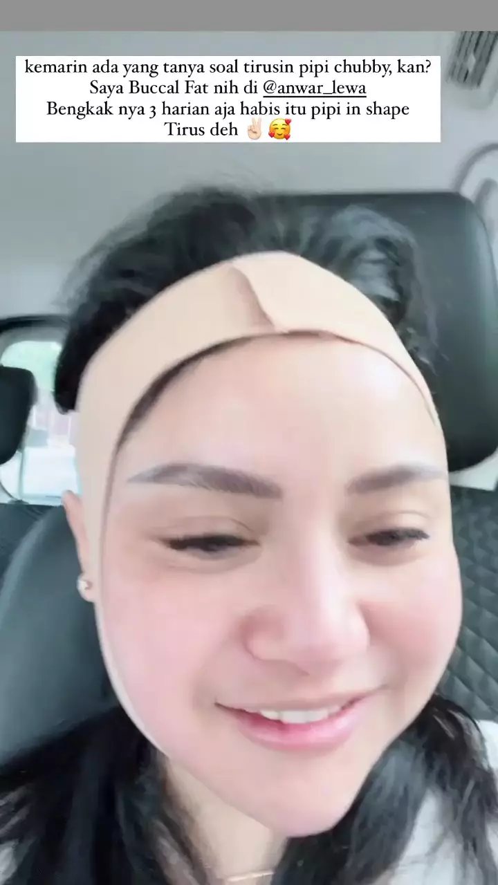 potret Mawar AFI jalani buccal fat © 2025 brilio.net