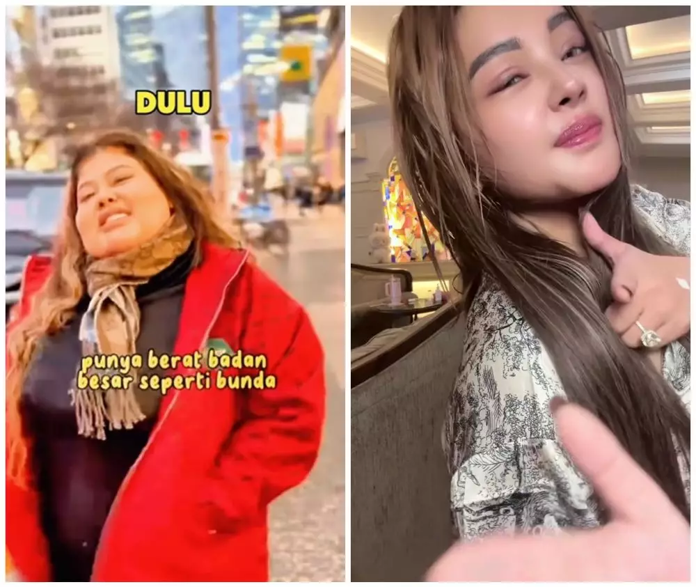 Shindy Samuel sebelum dan sesudah operasi plastik © Instagram Shindy Samuel sebelum dan sesudah operasi plastik © Instagram