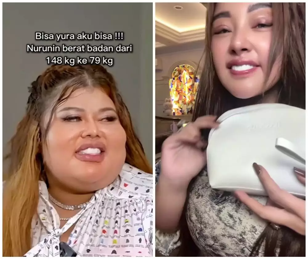 Shindy Samuel sebelum dan sesudah operasi plastik © Instagram Shindy Samuel sebelum dan sesudah operasi plastik © Instagram