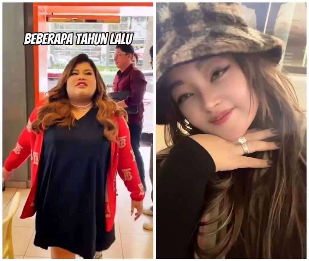 Shindy Samuel sebelum dan sesudah operasi plastik © Instagram Shindy Samuel sebelum dan sesudah operasi plastik © Instagram