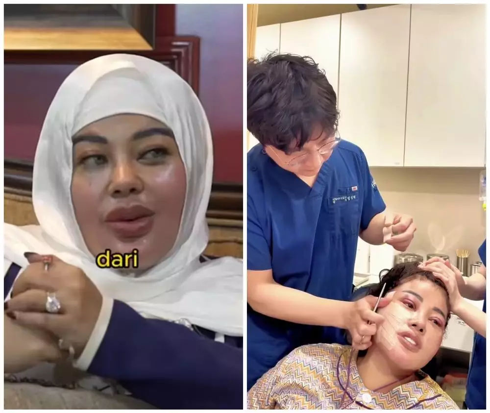 Shindy Samuel sebelum dan sesudah operasi plastik © Instagram Shindy Samuel sebelum dan sesudah operasi plastik © Instagram