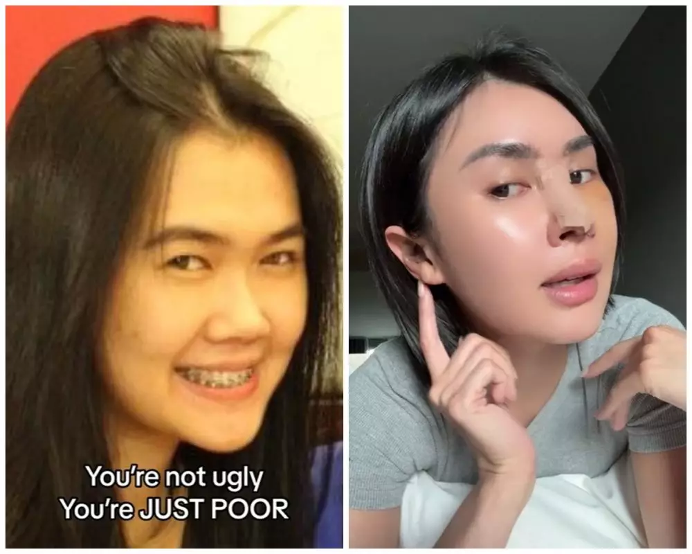 Michelle Halim sebelum dan sesudah operasi hidung © TikTok