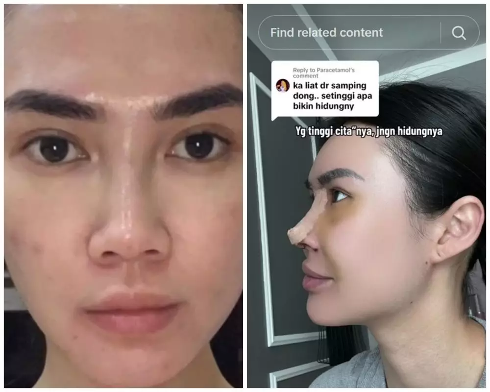 Michelle Halim sebelum dan sesudah operasi hidung © TikTok